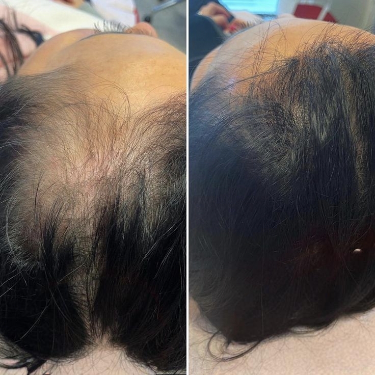 Laser Treatment Result 4