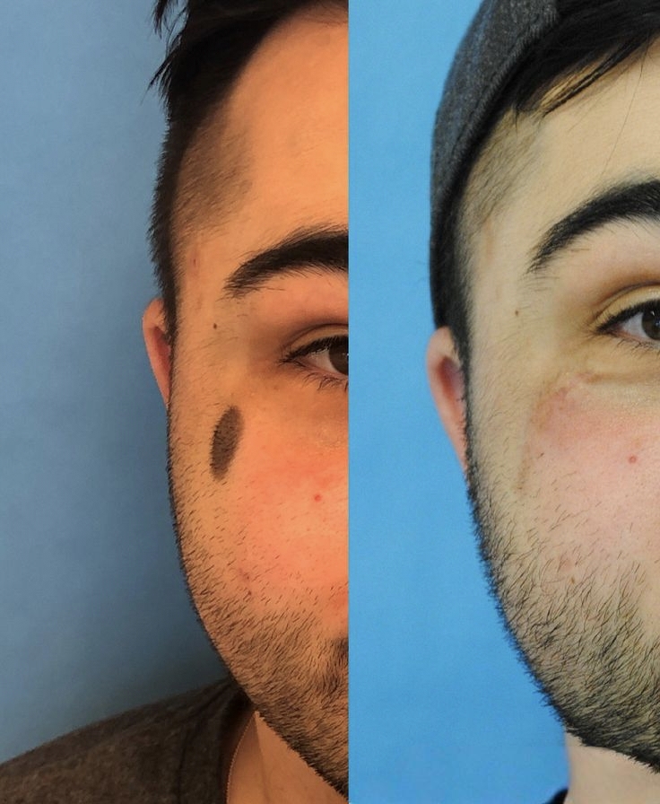 Facial Treatment Result 4