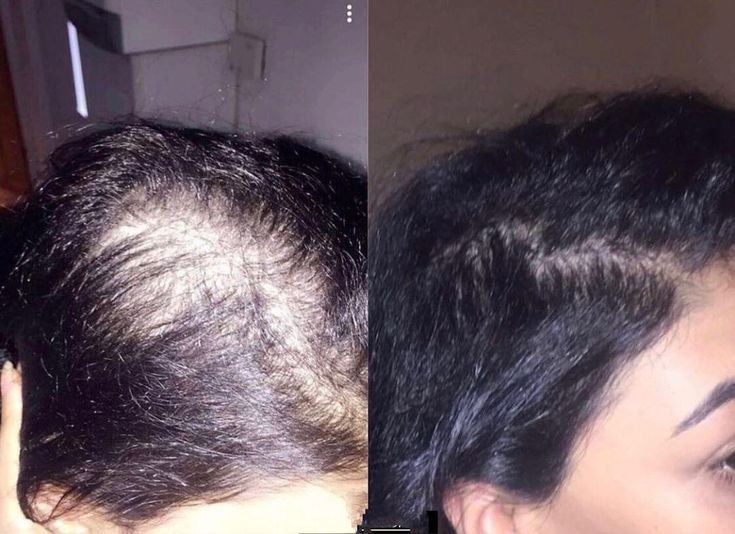 Hair Treatment Result 6